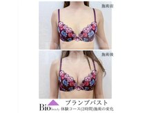 バイオビューティー 神戸本店(Bio Beauty)/プランプバスト　体験コース症例