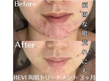 ホワイトアクア 中目黒店(WHITE AQUA)/ハーブピーリング 頑固な肌荒れ