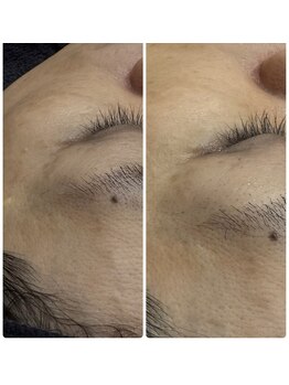 クラスペディア 嘉島店/たるみ改善!肌の弾力ハリを戻す