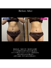 ドルチェビューティーサロン 戸塚安行店(Dolce Beauty Salon)/痩身（お腹・背中・脚）_施術1回