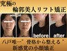 【たるんだ輪郭をV字フェイスに!】究極の輪郭美人リフト矯正