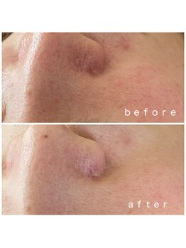 メナードフェイシャルサロン 岐阜茜部/毛穴ケア/くすみ/乾燥