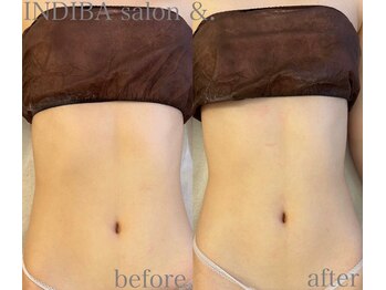 インディバサロン アンド(&.)/くびれ形成