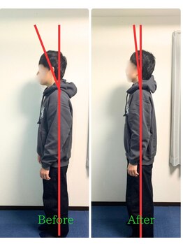 フリオ 天神整骨院/整体＆姿勢矯正ビフォーアフター