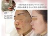 【ニキビ色素・凸凹ケア】ポイント再生★ヒト幹細胞ハーブ1.5g　60分