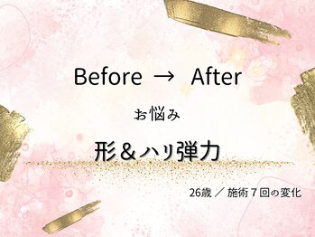 ロットプラス(Lot Plus)/バストアップ症例【C→Dカップ】