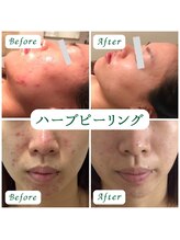 アネモネ 心斎橋院/ハーブピーリング