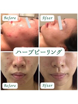 アネモネ 心斎橋院/ハーブピーリング