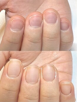 マリーロール 梅田店(Marie Laure)/自爪育成/深爪矯正/ネイルケア