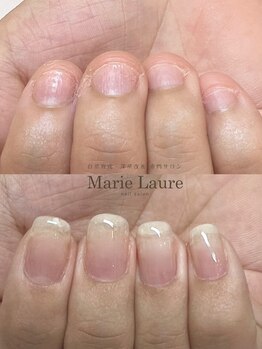 マリーロール 梅田店(Marie Laure)/自爪育成/深爪矯正/ネイルケア