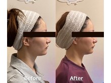 小顔22 ボルティ 赤坂支店(Bolty)/小顔シンメトリー矯正＆全身矯正