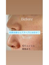 アヌヘア(Anuhea)/鼻の黒ずみ、毛穴、シミ悩みケア