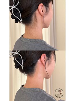 フォーエバービューティフル(Forever Beautiful)/Before & After