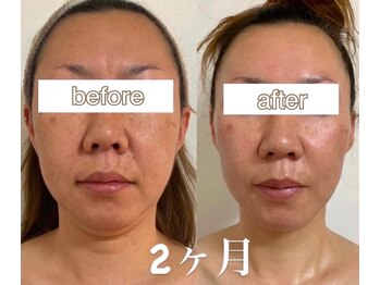 ラディアンス/小顔たるみ特化　40代