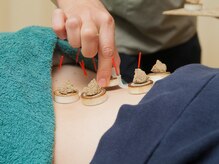 セントラルたなか鍼灸院 上社院/・鍼灸施術