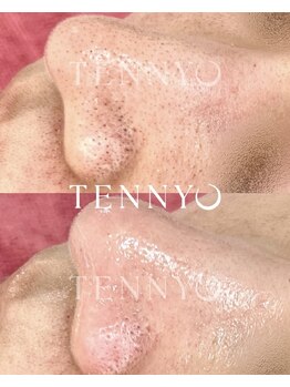 リセラージュ(Recellage)/TENNYO☆肌育毛穴洗浄