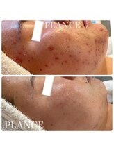 プランス 渋谷(PLANCE)/毛穴/ニキビケア/ハーブ