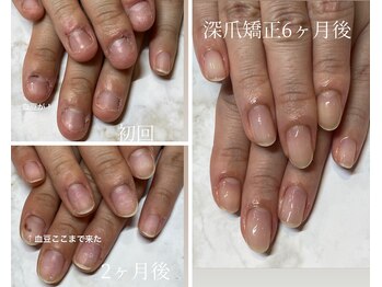 深爪矯正beforeafter