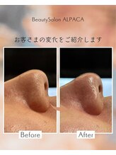 アルパカ(ALPACA)/毛穴のお悩み