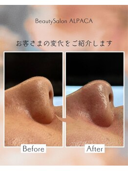 アルパカ(ALPACA)/毛穴のお悩み