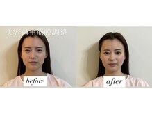 ヤマモト 表参道院(YAMAMOTO)/美容鍼＋筋膜調整