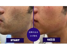 フェイシャル専門サロン サロン ド ウイッシュ/メンズひげ脱毛