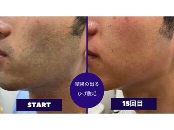 フェイシャル専門サロン サロン ド ウイッシュ/メンズひげ脱毛