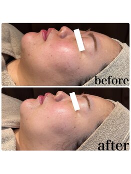 ディオーネ 春日井勝川店(Dione)/Dione美肌脱毛