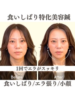 ハリアー(HARRIER)/【大阪本町】　食いしばり美容鍼