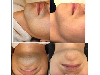 マーベリー(Marvelly)/メンズひげ脱毛