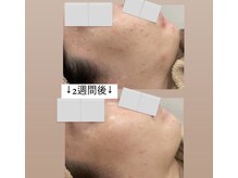 イミュ(Imyu.)の雰囲気（プラズマ微細針＋エクソソーム導入　最強肌改善）