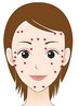 大人女性に人気【顔のむくみ改善/眼精疲労に】美容鍼60分