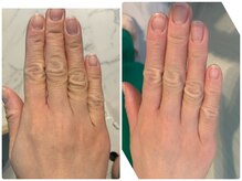 ルノン(LUNON)/希少よもぎ蒸しビフォーアフター