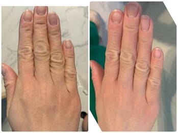 ルノン(LUNON)/希少よもぎ蒸しビフォーアフター