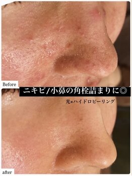 アリュール(ALLURE)/光ハイドロピーリング施術効果
