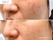 ビューティー ブロッサム(Beauty Blossom)/