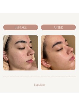 クプラニ 美浜店(kupulani)/ララピールbefore & after