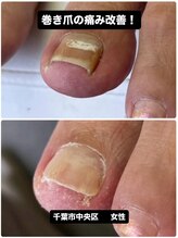 巻き爪じゅん 千葉駅前店/巻き爪はすぐ対処が鍵！