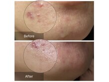 毛穴黒ずみ・ニキビ・シミケアなど肌の悩みに徹底アプローチ♪