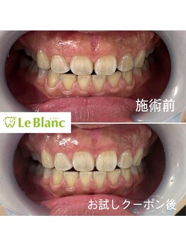 ルブラン 奈良店(Le Blanc)/もっと白くしたい!