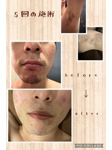 プルメリア/光脱毛メンズ