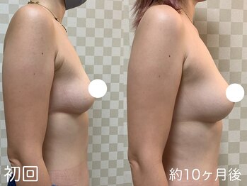 ハレオラ(HaleOla)/30代☆形も変わりハリがすごい♪