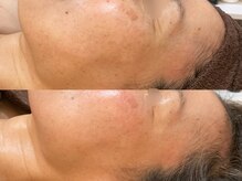 ビジュープラス 広島店(Bijou+)/【50代/シワ、たるみ】