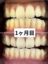 エクシアホワイトニング 京都四条店 1ヶ月目 歯の変化