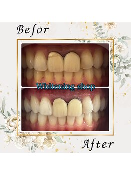 ホワイトニングショップ 宇都宮店/Before&After美白ホワイトニング