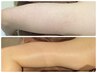 二の腕【REVI】触りたくなる肌へ！毛穴のぶつぶつ＆ザラつき徹底ケア￥6,600