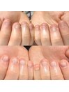 噛む癖がある深爪も緩和