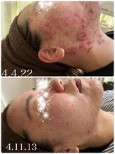 スペチアーレ 夙川/ニキビ改善、陶器肌に★