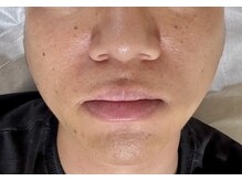 パーミル 千里丘店(per mille‰)/私の口周りのお写真です！