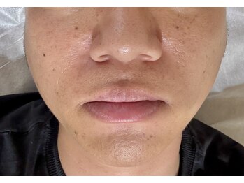 パーミル 千里丘店(per mille‰)/私の口周りのお写真です!